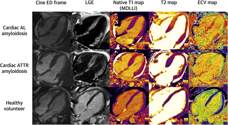 Cardiac magnetic resonance images comparing cardiac AL amyloidosis, cardiac ATTR amyloidosis and a healthy volunteer using cine imaging, late gadolinium enhancement, native T1 mapping, T2 mapping and extracellular volume mapping.