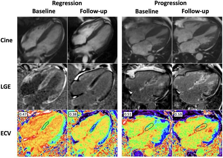 Serial cardiac magnetic resonance images comparing regression and progression of transthyretin cardiac amyloidosis using cine imaging, late gadolinium enhancement, and extracellular volume mapping at baseline and follow-up.