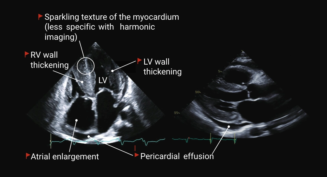 Echocardiographic images illustrating cardiac amyloidosis red flags, including left and right ventricular wall thickening, atrial enlargement, pericardial effusion and increased myocardial echogenicity.