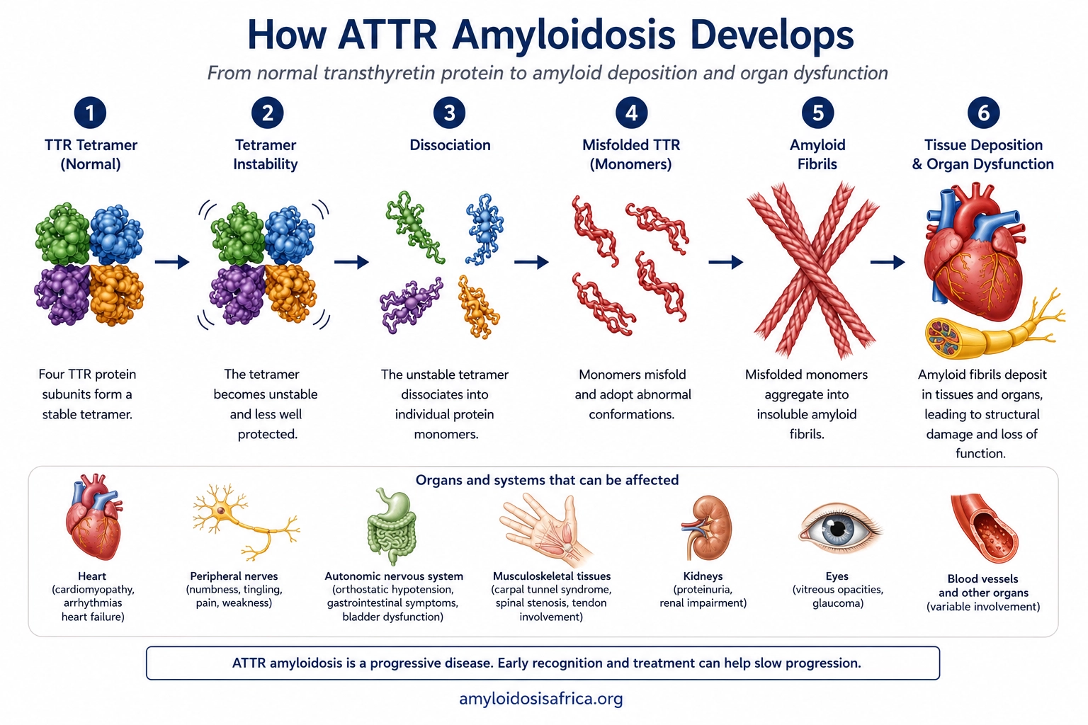 How ATTR amyloidosis develops from transthyretin tetramer instability and protein misfolding to amyloid fibril formation, tissue deposition and organ dysfunction.