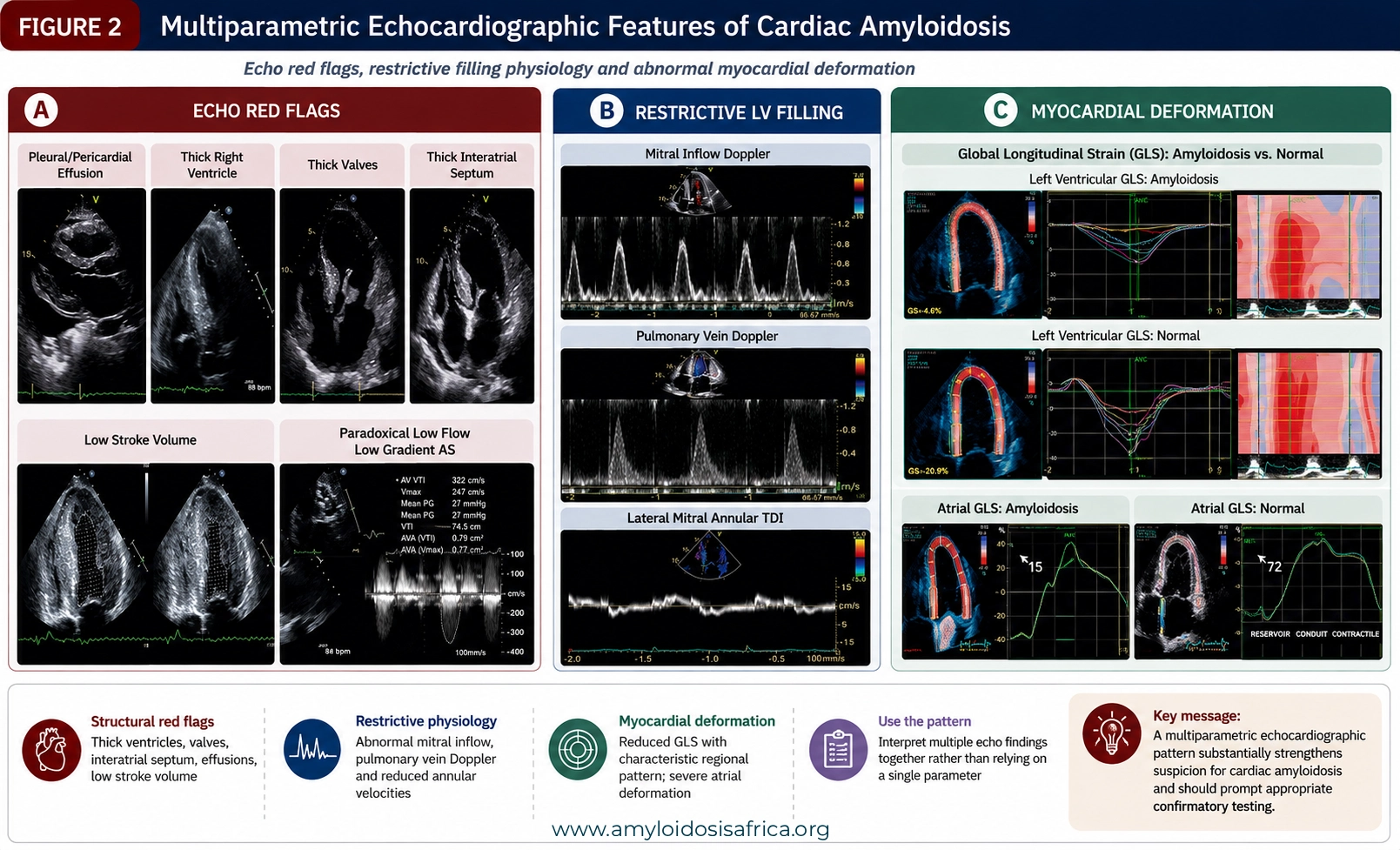 Composite echocardiography figure showing structural red flags, restrictive left ventricular filling and global longitudinal strain abnormalities associated with cardiac amyloidosis.