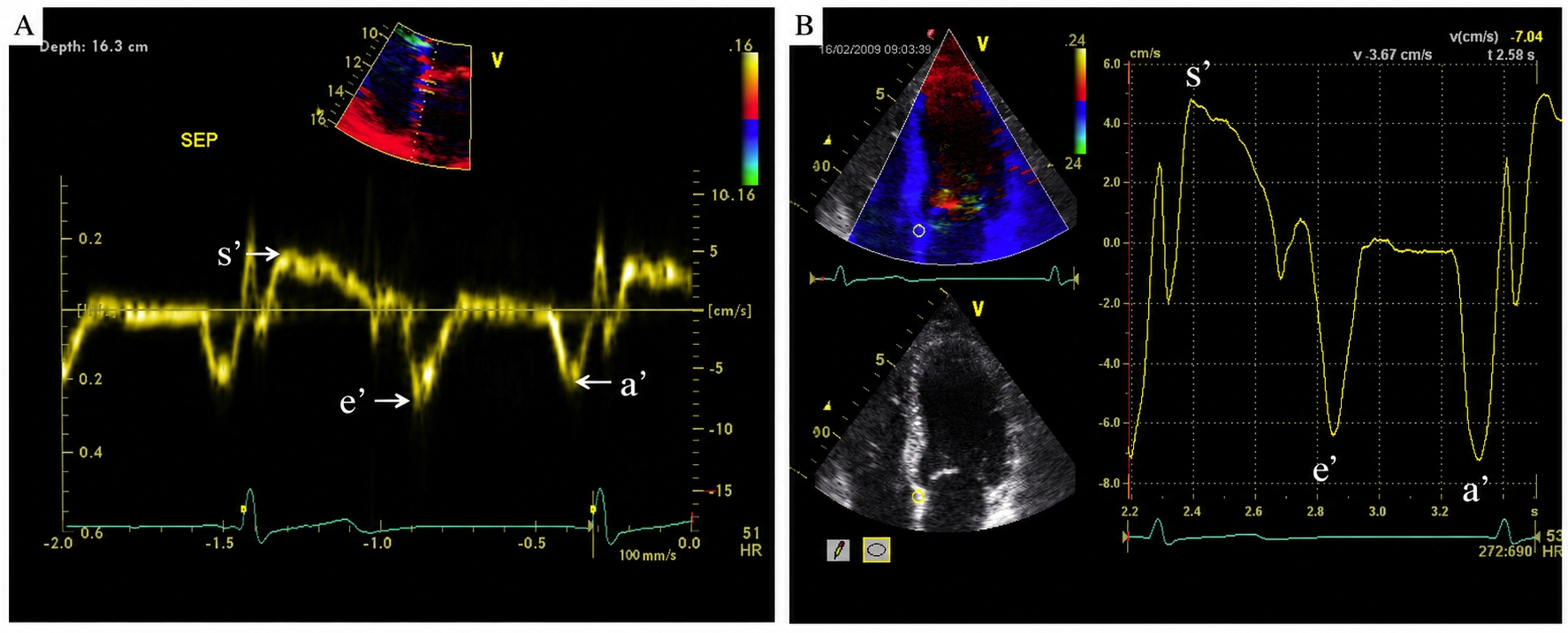 Tissue Doppler imaging in cardiac amyloidosis showing reduced mitral annular systolic S′, early diastolic e′, and late diastolic a′ velocities, illustrating the 5-5-5 sign.