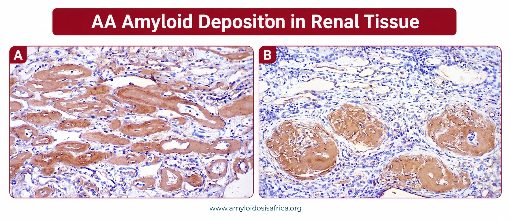 Kidney histology images showing AA amyloid deposition in renal tissue, including amyloid deposits involving glomerular and tubulointerstitial structures.