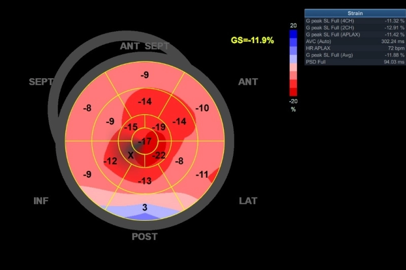 Echocardiography in cardiac amyloidosis showing a GLS bull’s-eye strain map with relative apical sparing, also known as the cherry-on-top pattern.