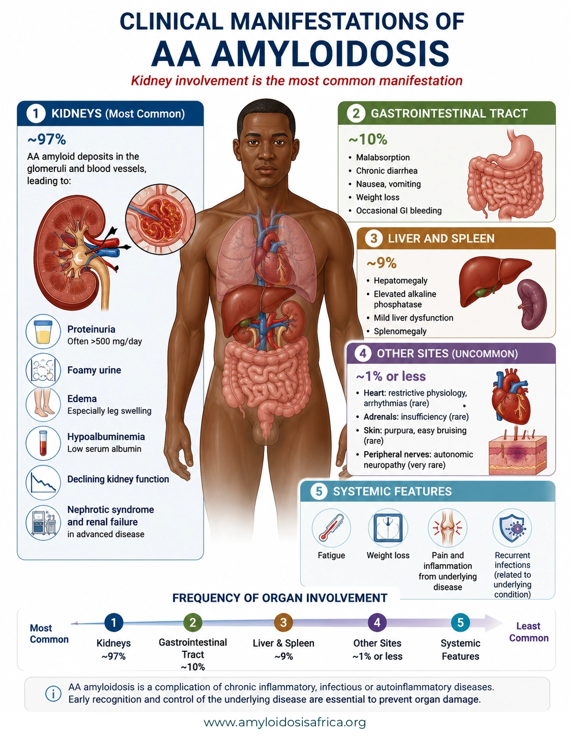 Clinical manifestations of AA amyloidosis infographic showing the kidneys as the most commonly affected organs, with proteinuria, nephrotic syndrome, edema and declining kidney function, alongside gastrointestinal, liver, spleen and less common organ involvement.