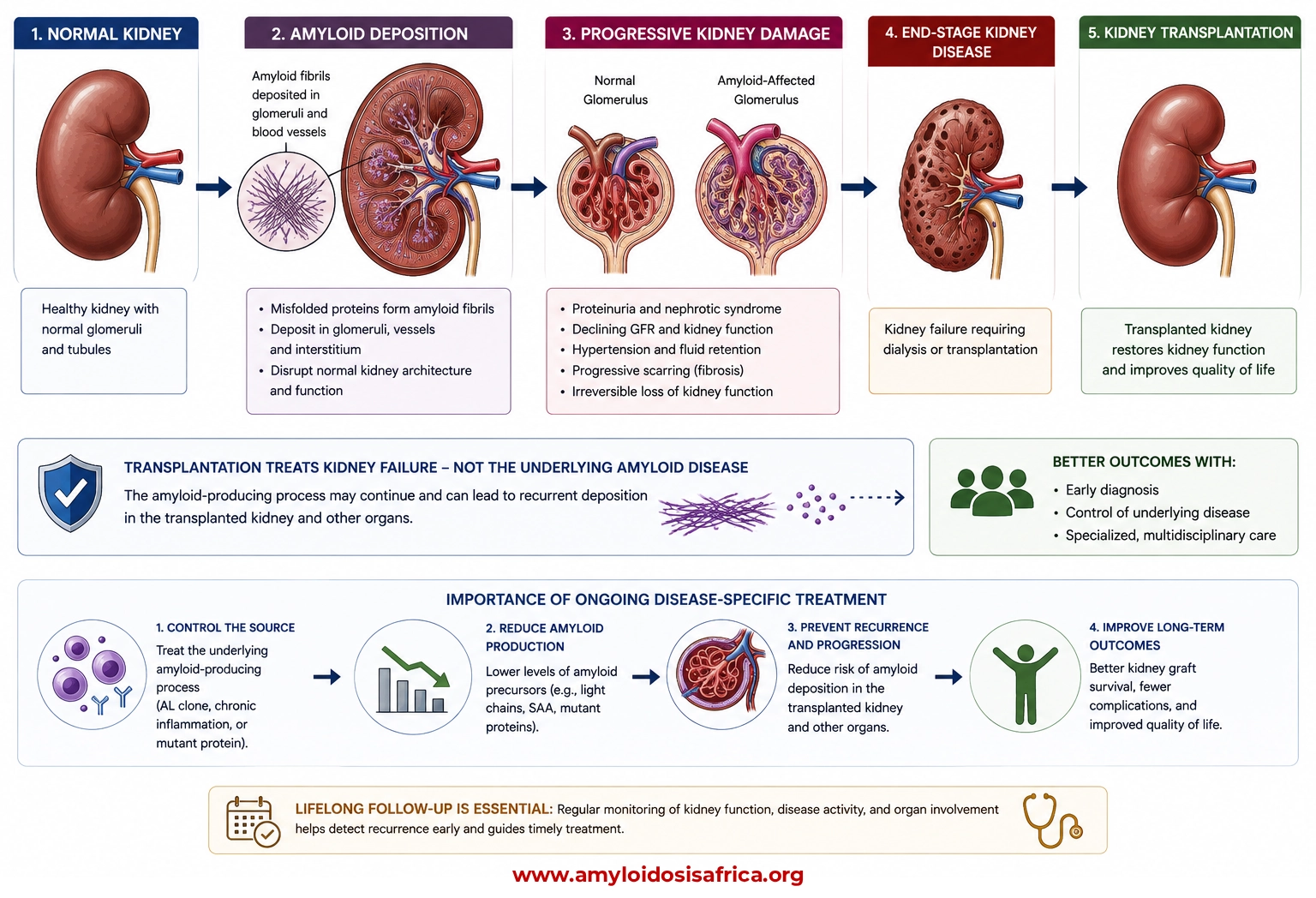 Renal amyloid deposition pathway showing progressive kidney damage, end-stage kidney disease, kidney transplantation, and the importance of ongoing amyloidosis treatment to reduce recurrence.