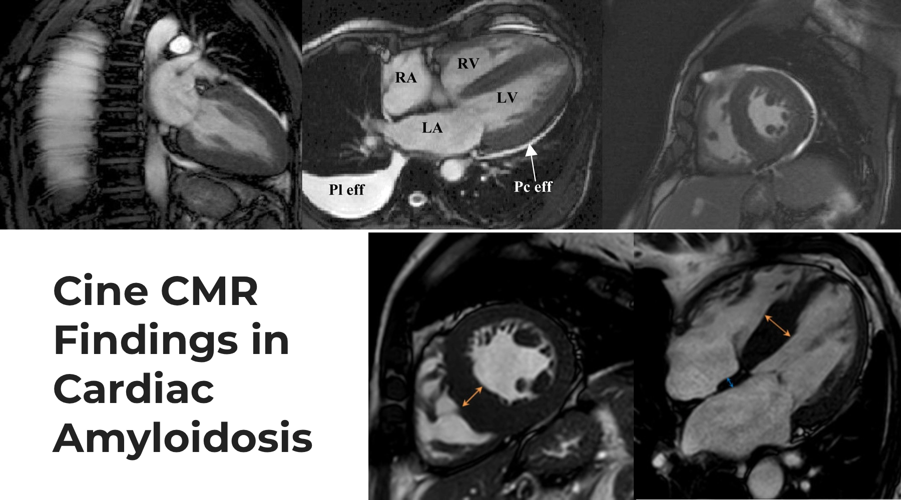 Cine cardiac magnetic resonance images demonstrating increased ventricular wall thickness, cardiac chamber morphology, and associated pleural and pericardial effusions in cardiac amyloidosis, with long-axis and short-axis CMR views.