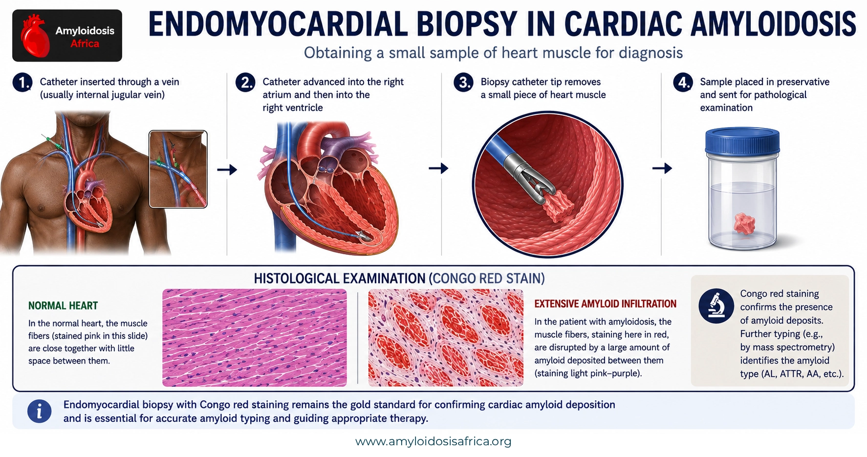 Medical illustration showing the endomyocardial biopsy procedure in cardiac amyloidosis, including venous catheter insertion, advancement into the right ventricle, myocardial tissue sampling, specimen collection, and histological examination for amyloid deposits.