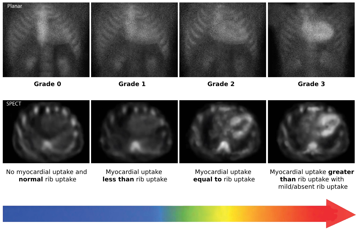 Planar and SPECT bone scintigraphy showing Perugini Grades 0 to 3 in cardiac amyloidosis, progressing from no myocardial tracer uptake to uptake greater than rib uptake.