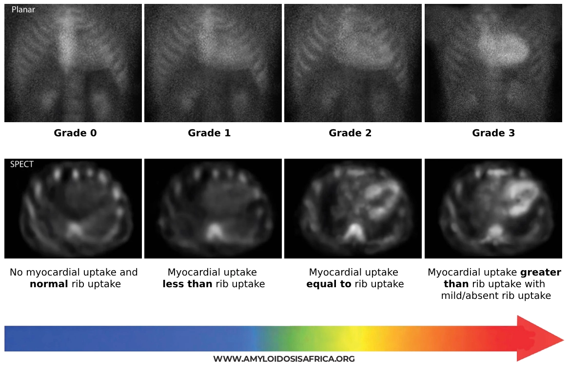 Cardiac amyloidosis diagnosis with bone scintigraphy showing planar and SPECT Perugini grades 0 to 3, from no myocardial uptake to uptake greater than rib uptake.