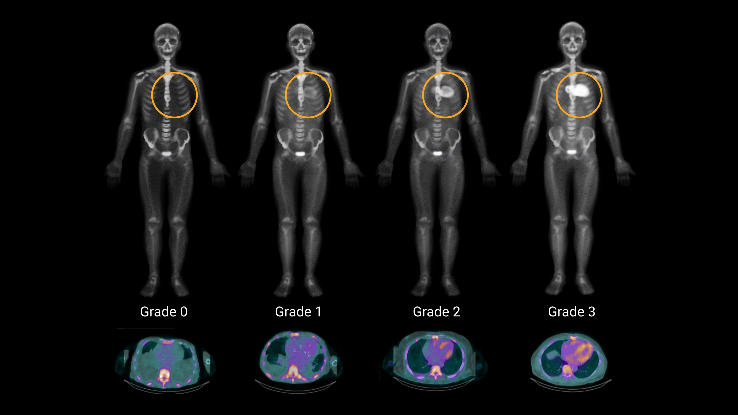 Bone scintigraphy and SPECT/CT examples showing progressively increasing cardiac tracer uptake from Grade 0 through Grade 3.