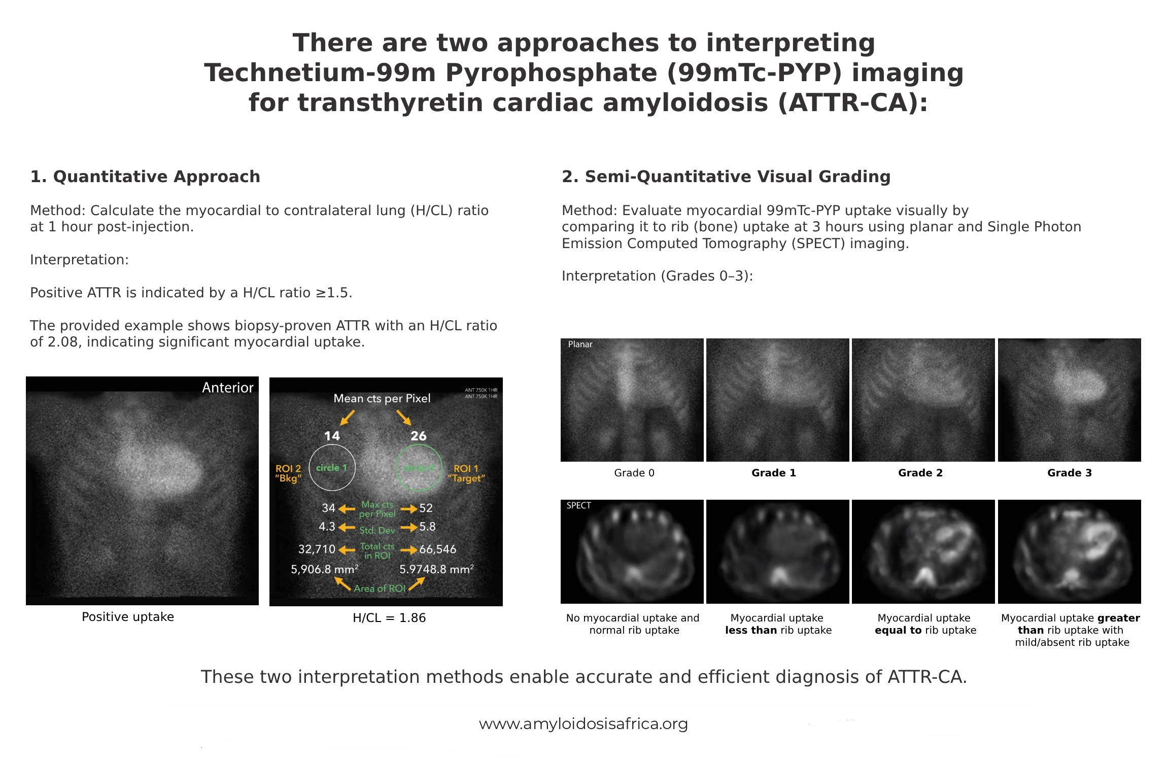 Technetium-99m PYP imaging in transthyretin cardiac amyloidosis showing two interpretation methods: quantitative heart-to-contralateral chest ratio measurement and semi-quantitative visual grading from Grade 0 to Grade 3 using planar and SPECT imaging.