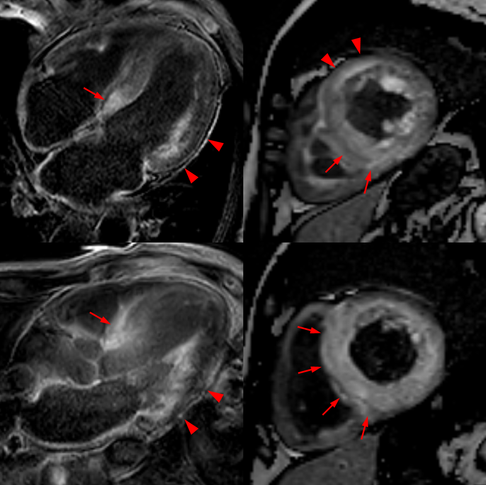 Cardiac magnetic resonance images showing characteristic late gadolinium enhancement patterns in cardiac amyloidosis, including diffuse subendocardial and more extensive myocardial enhancement in long-axis and short-axis views.