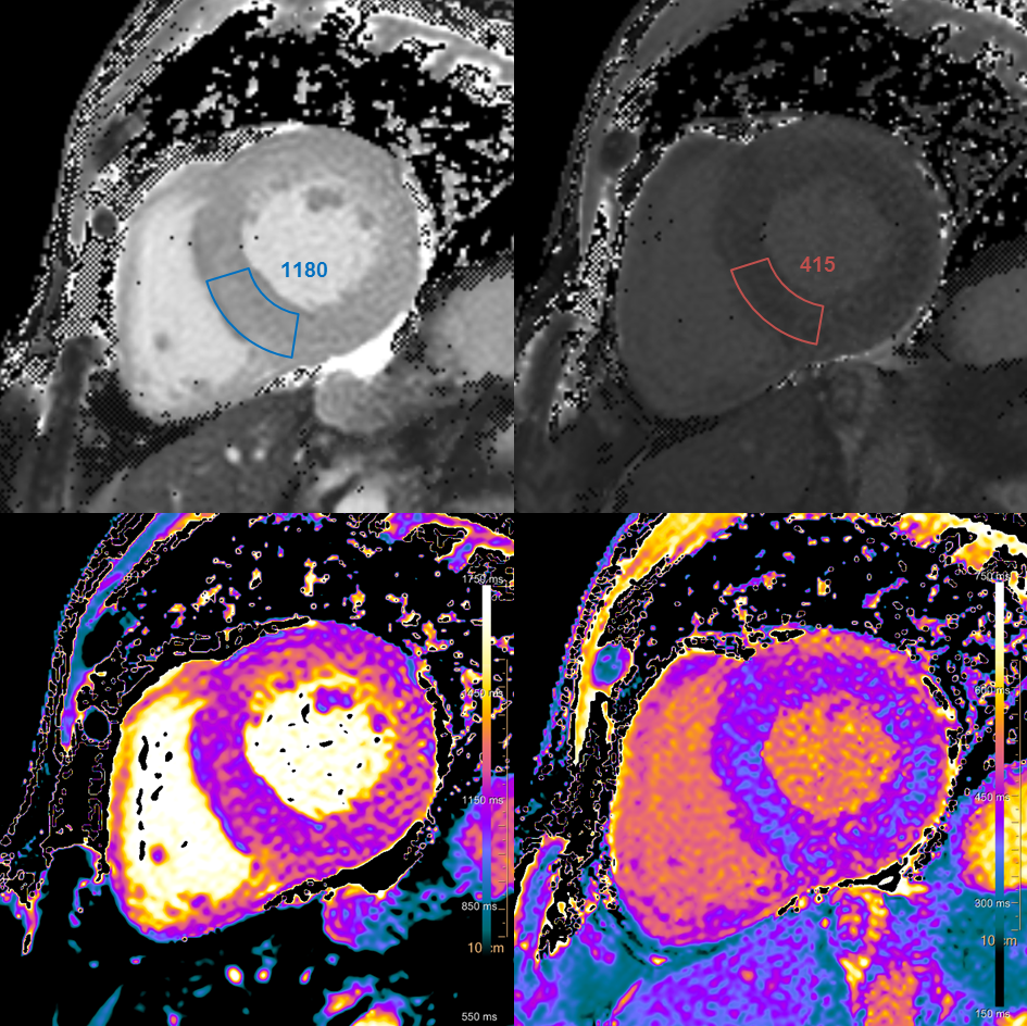 Cardiac magnetic resonance T1 mapping images in wild-type transthyretin cardiac amyloidosis, showing elevated native myocardial T1 and post-contrast T1 measurements in short-axis views.