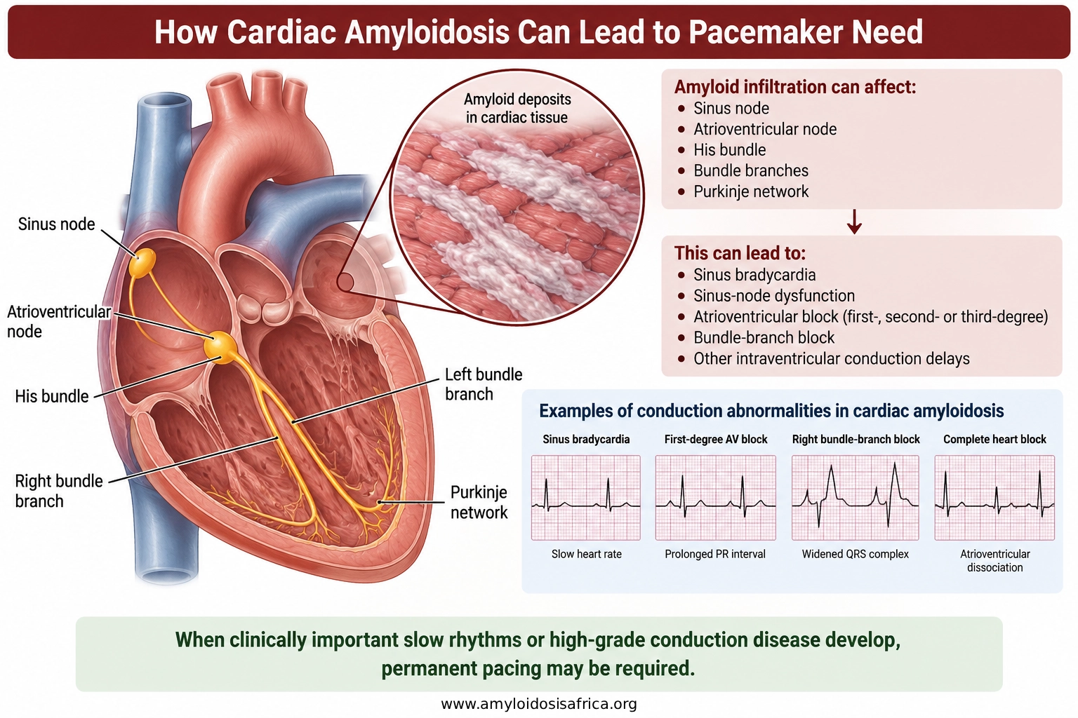 Cardiac amyloidosis affecting the heart conduction system, including the sinus node, AV node, His bundle and bundle branches, leading to bradycardia, heart block and possible pacemaker need