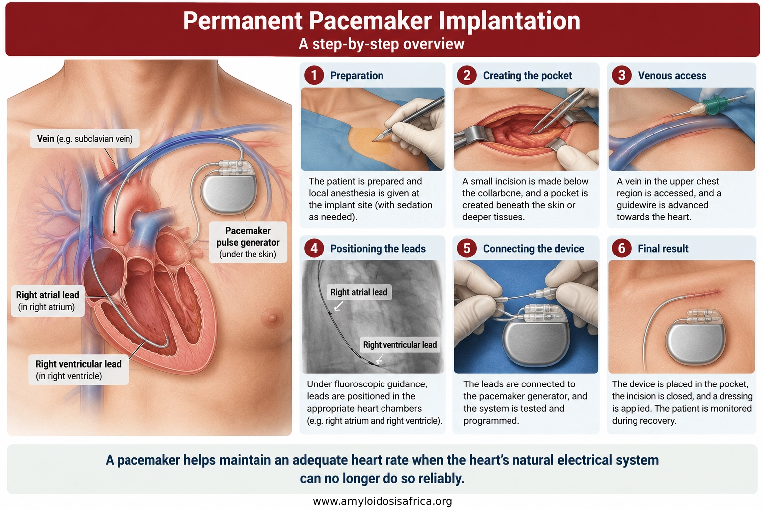 Permanent pacemaker implantation showing transvenous leads advanced through a vein into the right atrium and right ventricle and connected to a pulse generator in the upper chest