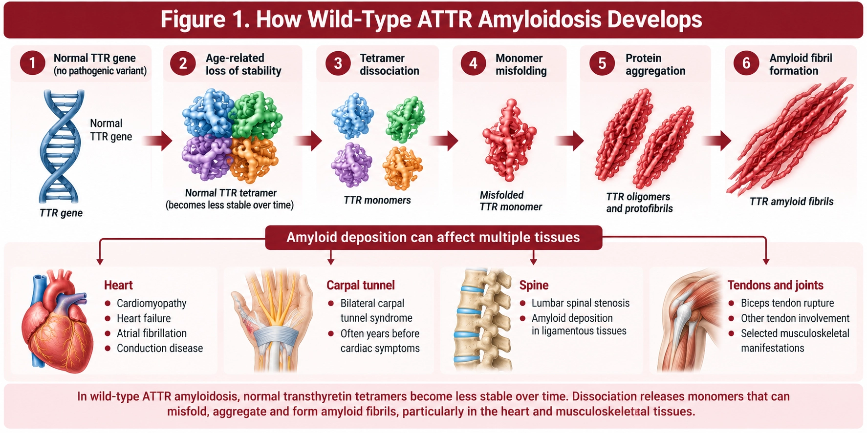Wild-type ATTR amyloidosis pathway showing normal transthyretin tetramers becoming unstable, dissociating into monomers, misfolding and forming amyloid fibrils that deposit in the heart and musculoskeletal tissues