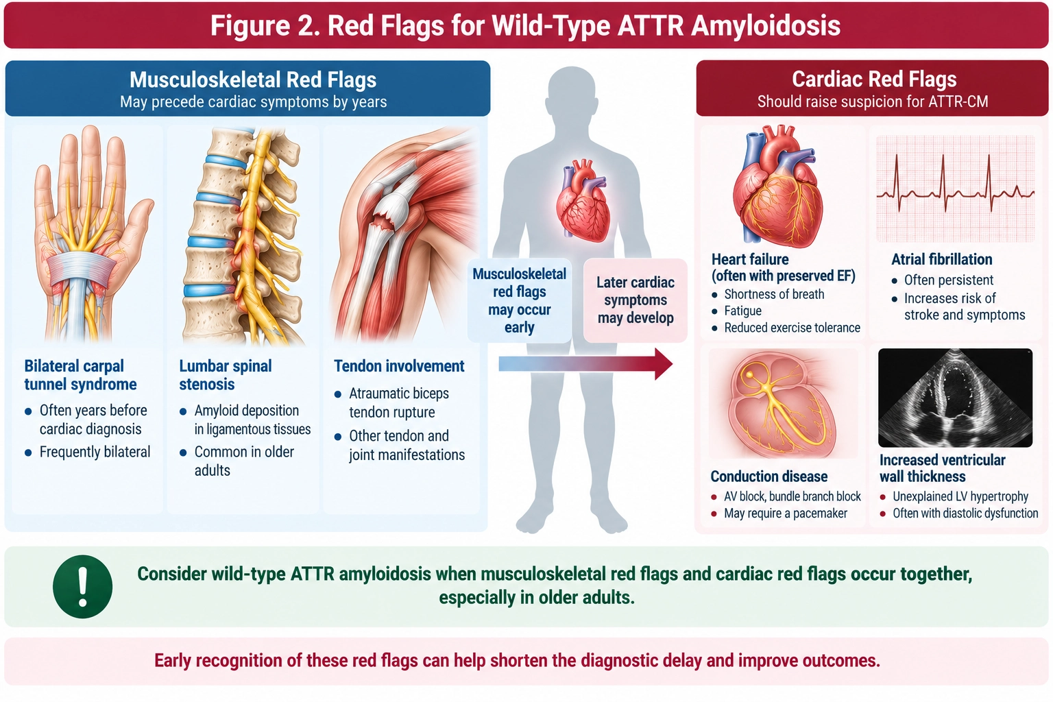Red flags for wild-type ATTR amyloidosis showing bilateral carpal tunnel syndrome, lumbar spinal stenosis and tendon involvement preceding heart failure, atrial fibrillation, conduction disease and increased ventricular wall thickness