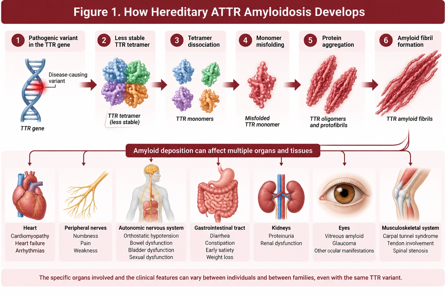 Hereditary ATTR amyloidosis pathway showing a pathogenic TTR gene variant causing transthyretin tetramer instability, monomer misfolding and amyloid fibril formation affecting multiple organs