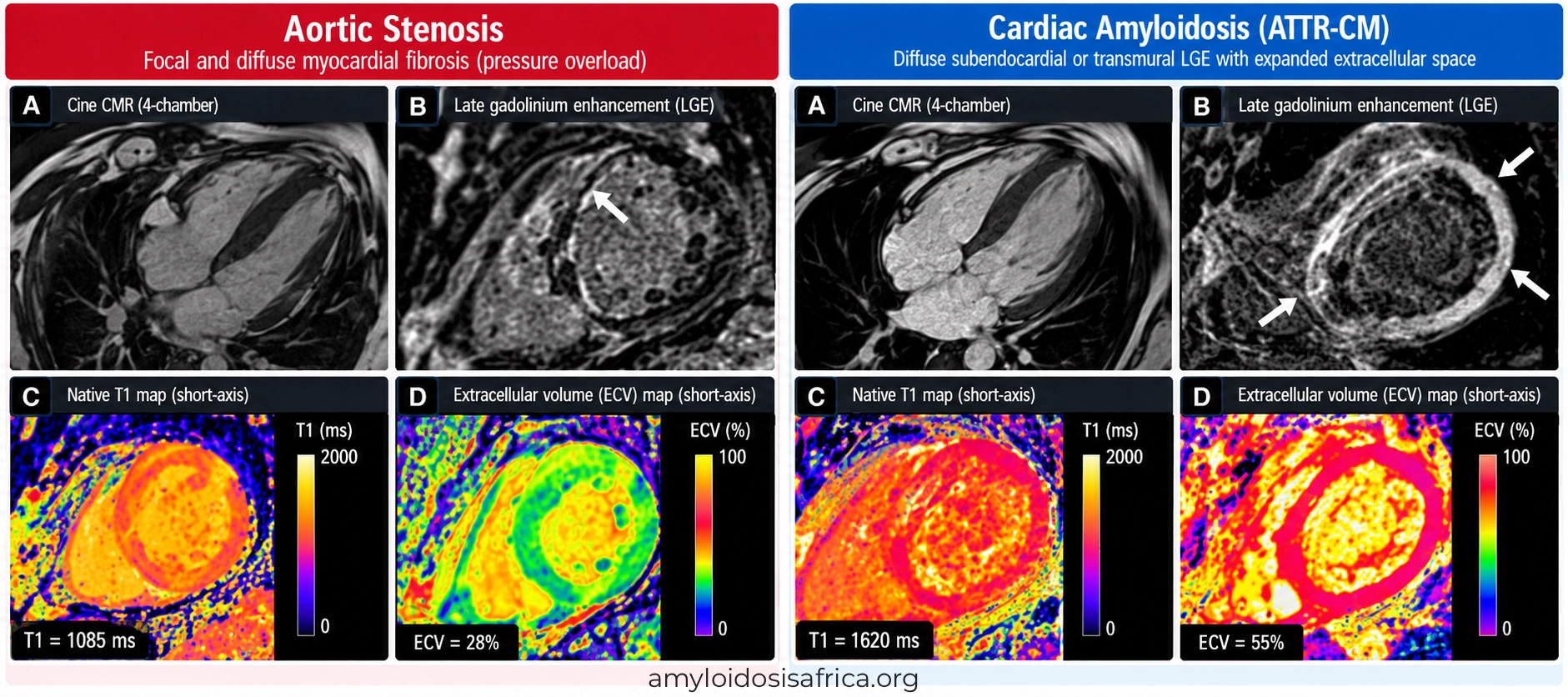 Cardiac MRI comparison of aortic stenosis and ATTR cardiac amyloidosis showing late gadolinium enhancement (LGE), native T1 mapping and extracellular volume (ECV), highlighting myocardial fibrosis versus diffuse amyloid infiltration.