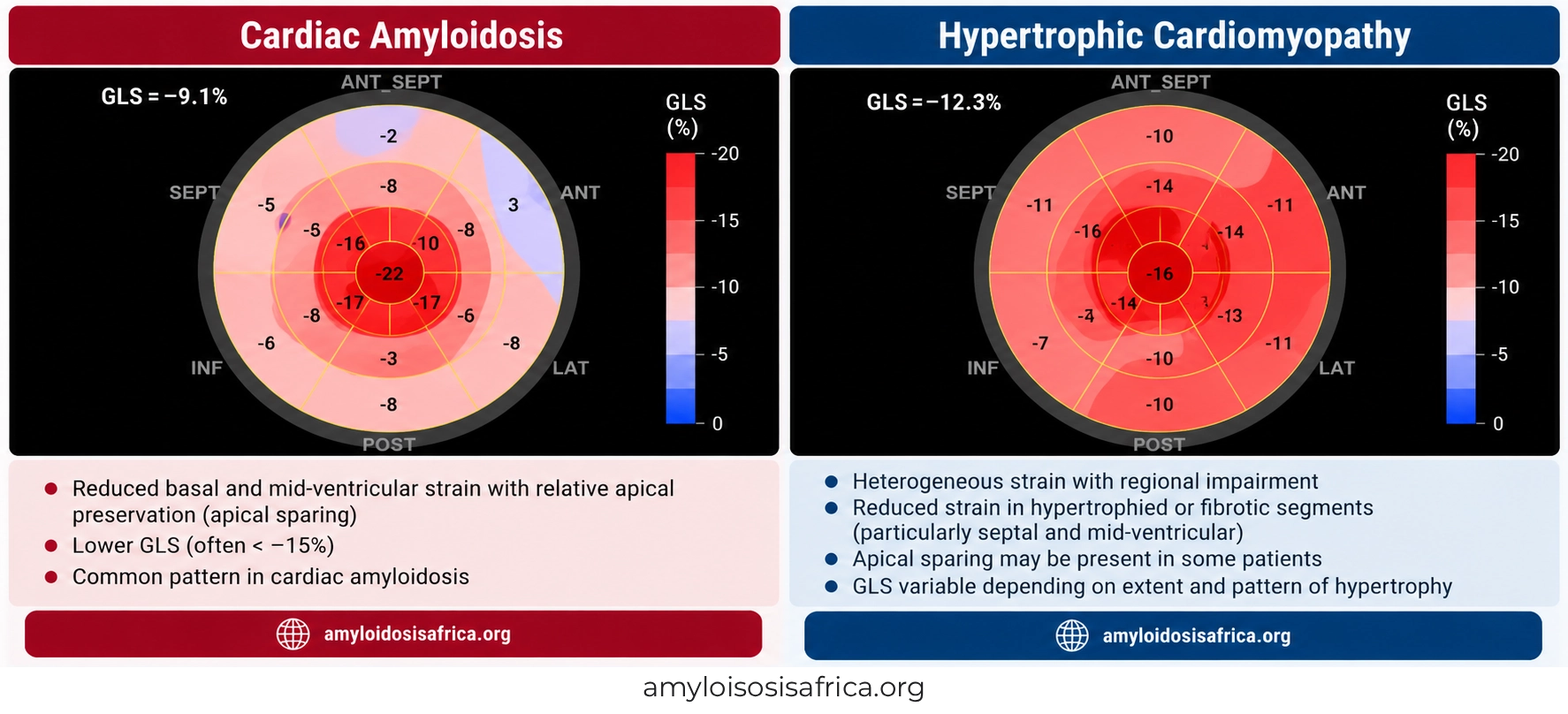 Global longitudinal strain (GLS) bull's-eye maps comparing cardiac amyloidosis with relative apical sparing and hypertrophic cardiomyopathy with heterogeneous regional strain impairment.