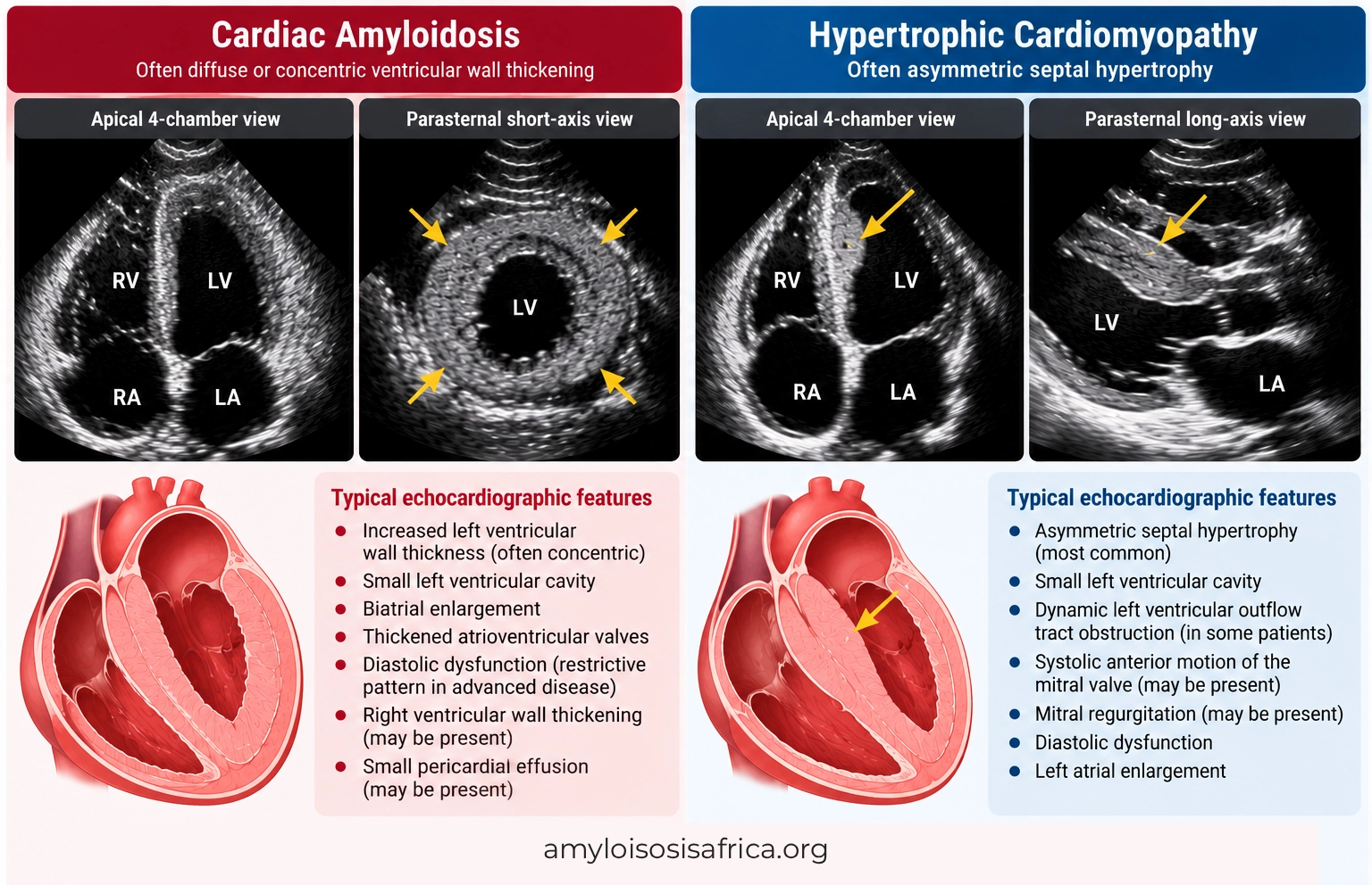 Cardiac amyloidosis versus hypertrophic cardiomyopathy comparison showing echocardiographic views, concentric ventricular wall thickening in amyloidosis and asymmetric septal hypertrophy in HCM.