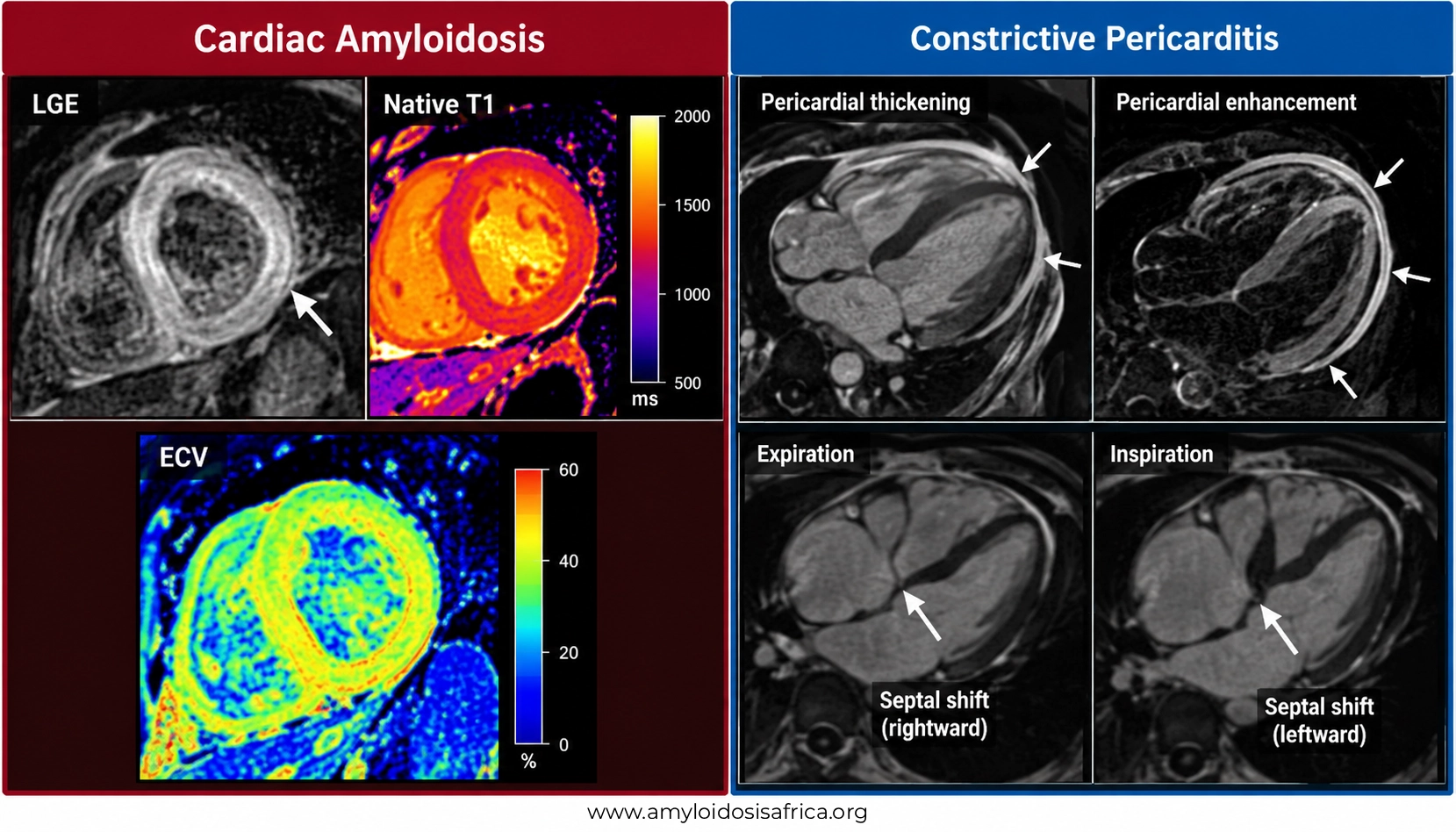 Cardiac MRI illustration comparing cardiac amyloidosis and constrictive pericarditis, showing myocardial LGE, native T1 and ECV mapping, pericardial thickening, enhancement and respiratory septal shift.