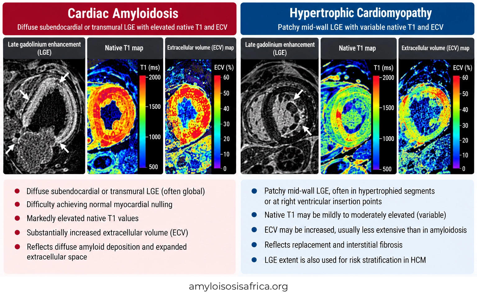 Cardiac MRI comparison of cardiac amyloidosis and hypertrophic cardiomyopathy showing late gadolinium enhancement (LGE), native T1 mapping and extracellular volume (ECV), highlighting diffuse myocardial infiltration in amyloidosis versus patchy fibrosis in HCM.