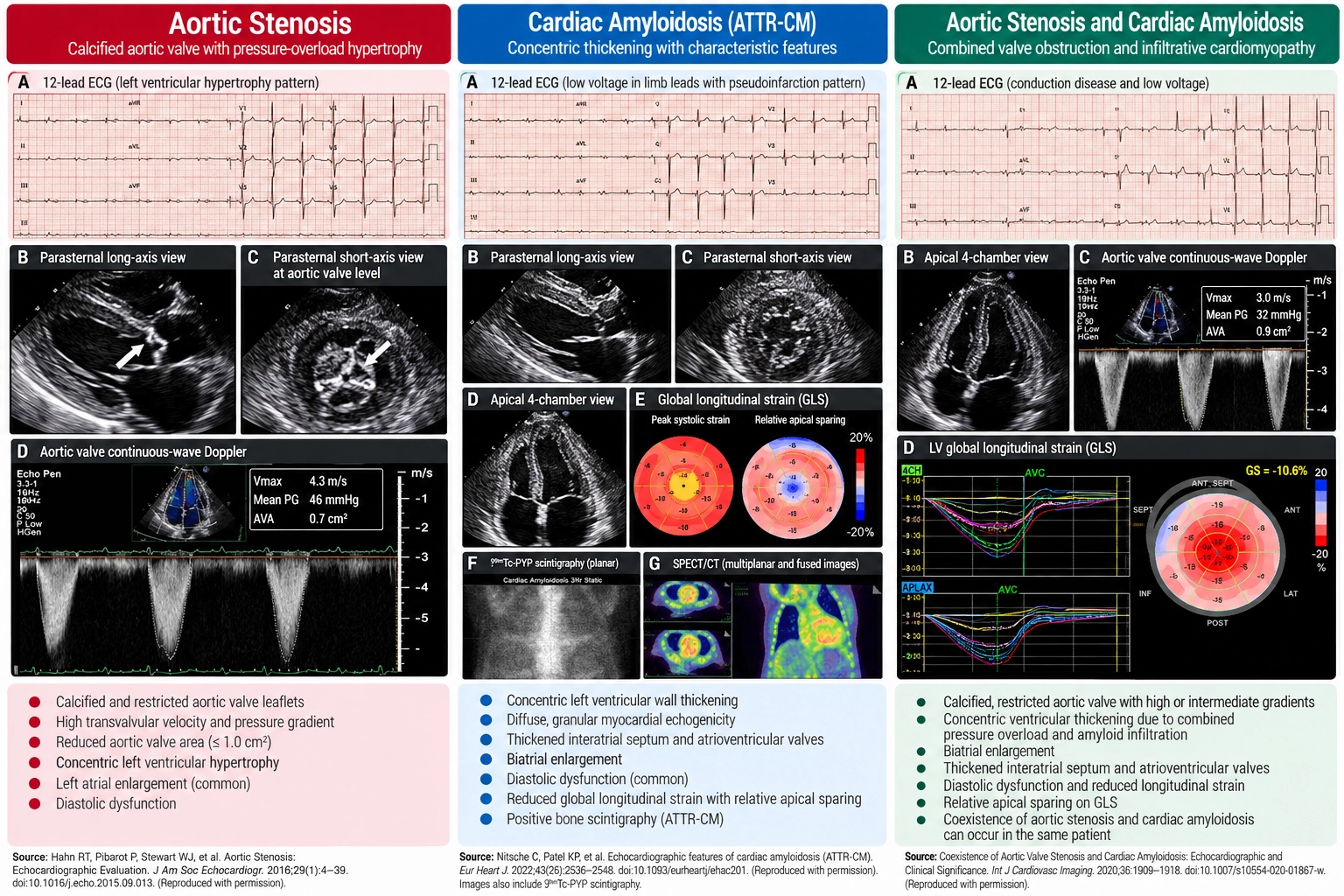 Clinical imaging comparison of aortic stenosis, ATTR cardiac amyloidosis and coexisting disease, showing echocardiography, aortic valve Doppler, ventricular wall thickening, global longitudinal strain and cardiac scintigraphy.