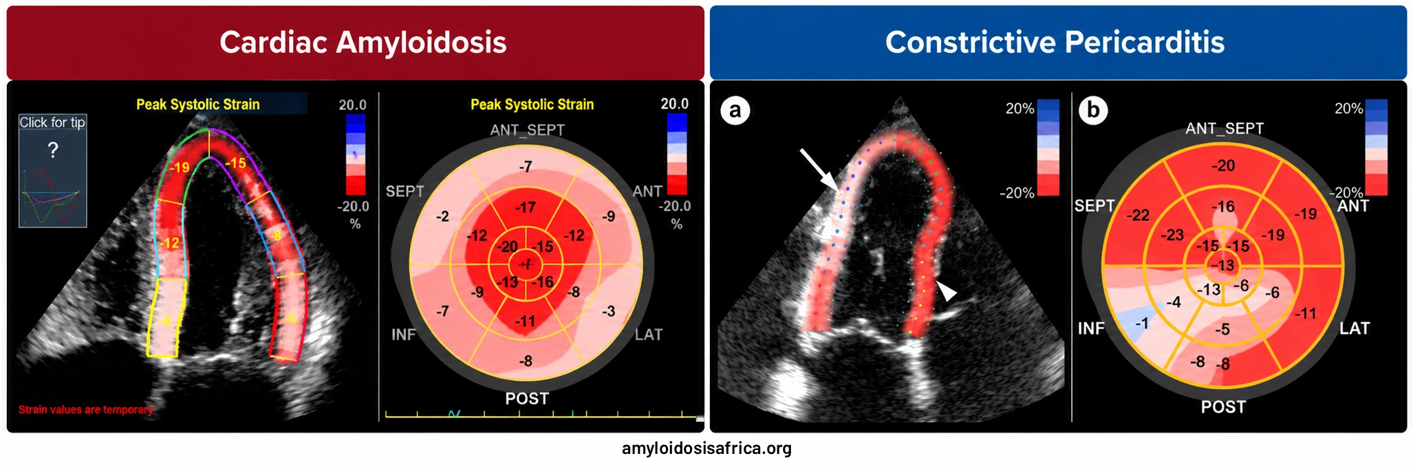 Speckle-tracking echocardiography comparing cardiac amyloidosis and constrictive pericarditis, showing longitudinal strain maps and regional myocardial deformation patterns.
