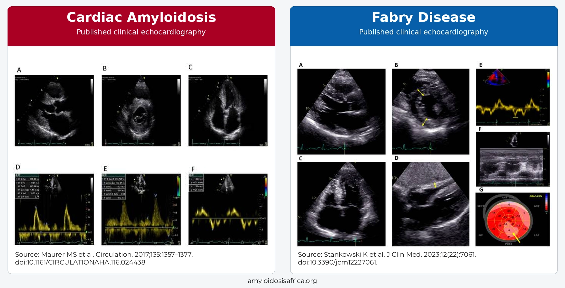 Published echocardiographic images comparing cardiac amyloidosis and Fabry disease, showing ventricular wall thickening, cardiac structural changes and myocardial strain abnormalities.