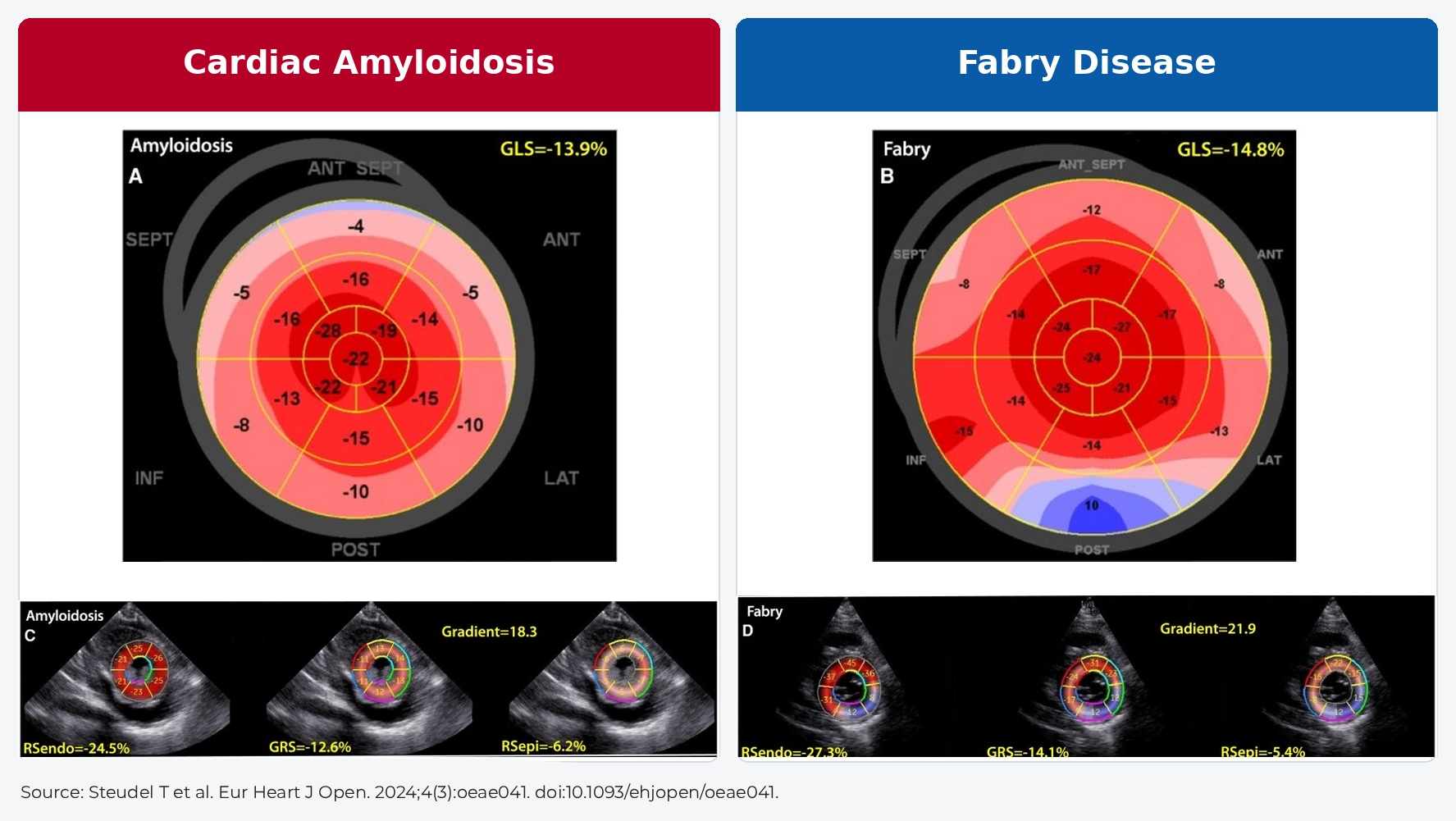 Published GLS bull’s-eye maps comparing cardiac amyloidosis and Fabry disease, showing relative apical sparing, regional strain abnormalities and myocardial layer strain differences.