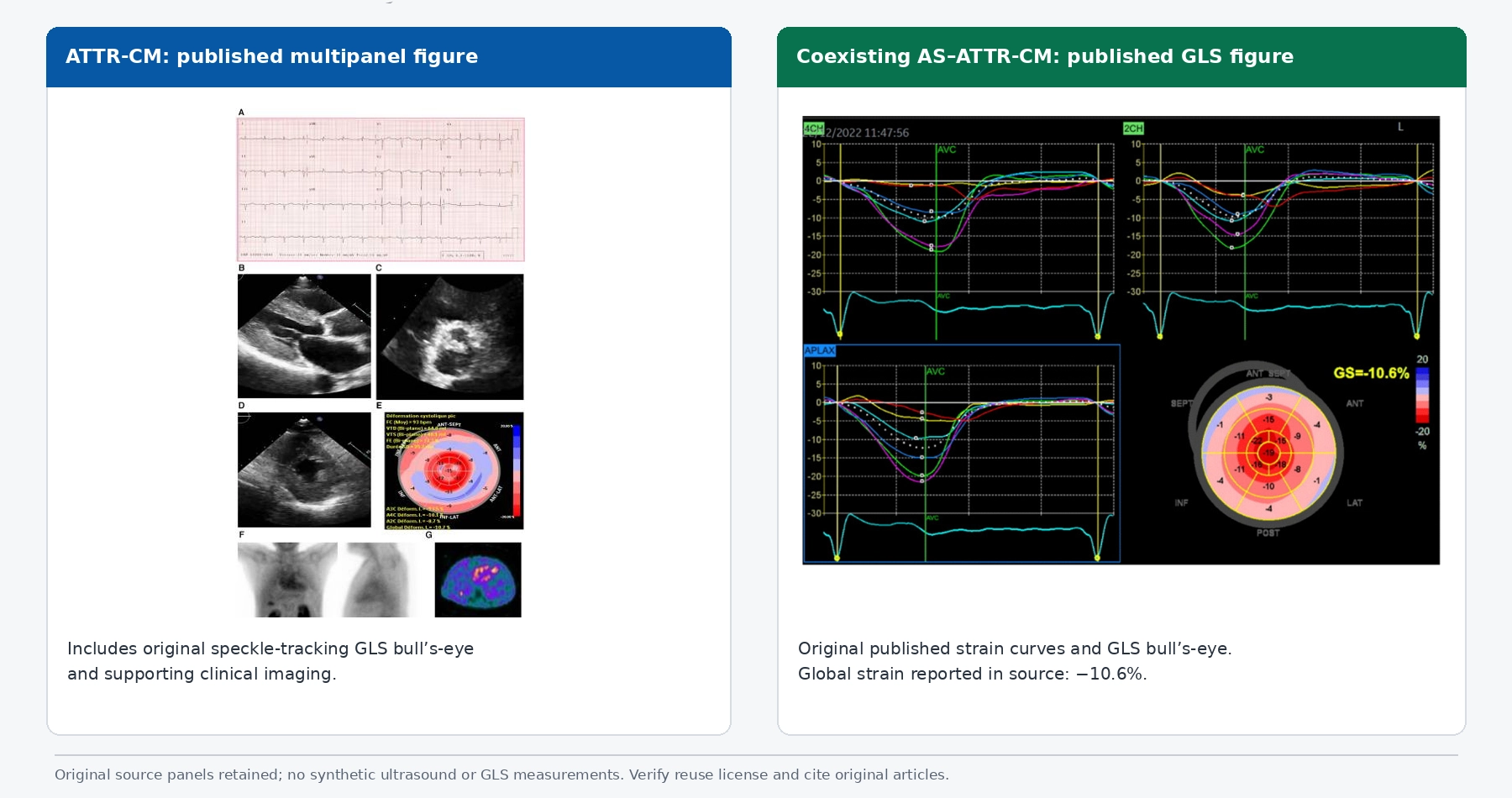 Published global longitudinal strain (GLS) images comparing ATTR cardiac amyloidosis with coexisting aortic stenosis and ATTR-CM, showing speckle-tracking strain curves, bull’s-eye maps and relative apical sparing.