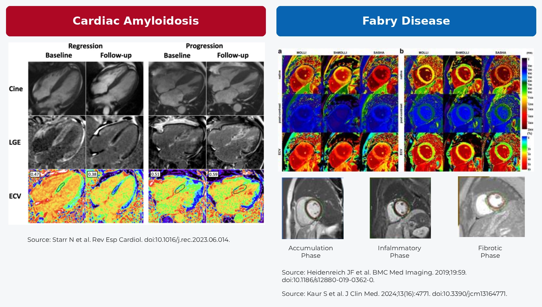 Published cardiac MRI images comparing cardiac amyloidosis and Fabry disease using late gadolinium enhancement (LGE), native T1 mapping and extracellular volume (ECV) assessment.