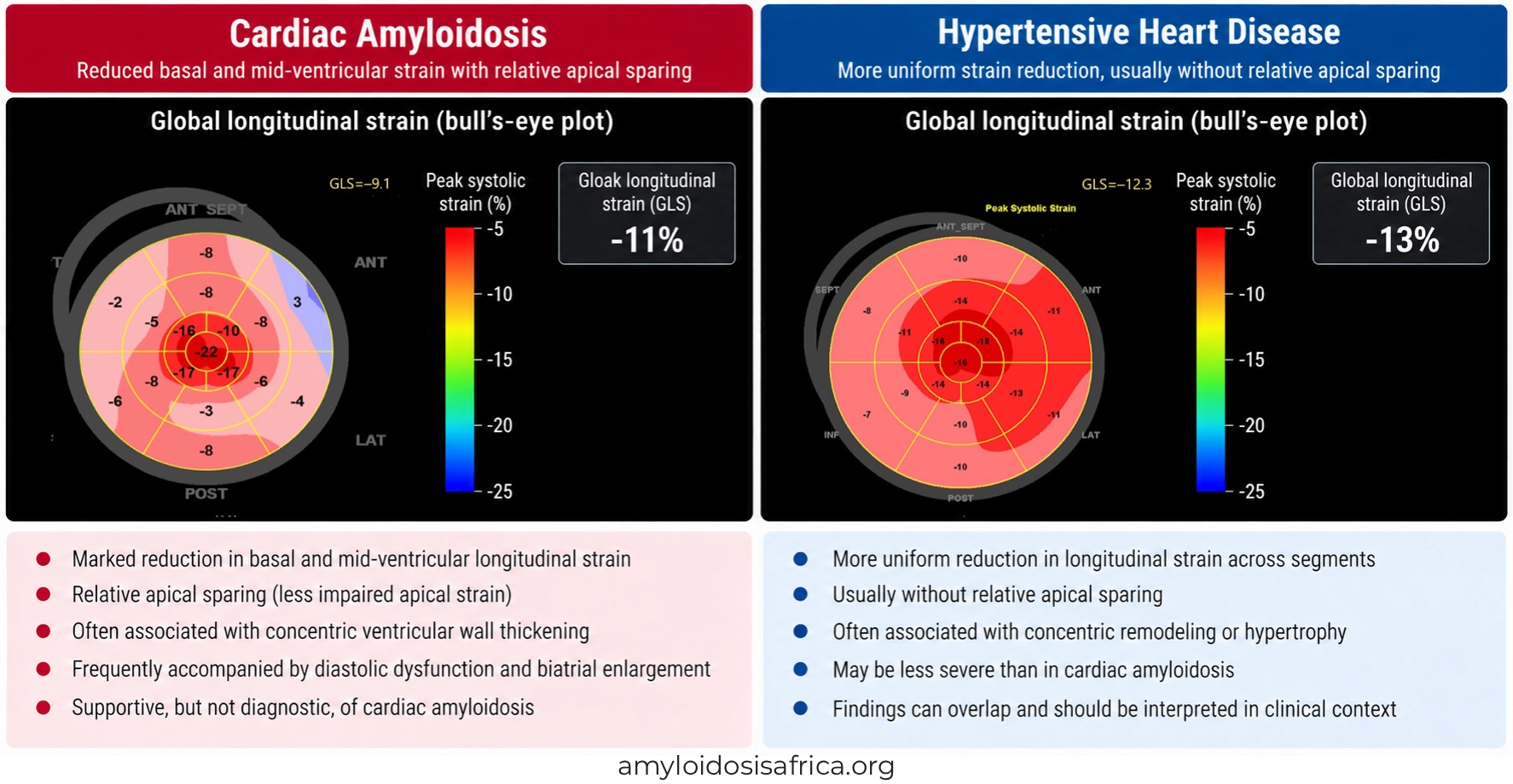 Global longitudinal strain (GLS) bull's-eye plots comparing cardiac amyloidosis with relative apical sparing and hypertensive heart disease with more uniform longitudinal strain impairment.