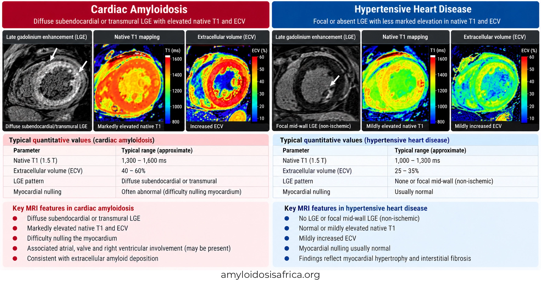 Cardiac MRI comparison of cardiac amyloidosis and hypertensive heart disease showing late gadolinium enhancement (LGE), native T1 mapping and extracellular volume (ECV), highlighting diffuse amyloid infiltration versus hypertension-related myocardial fibrosis.