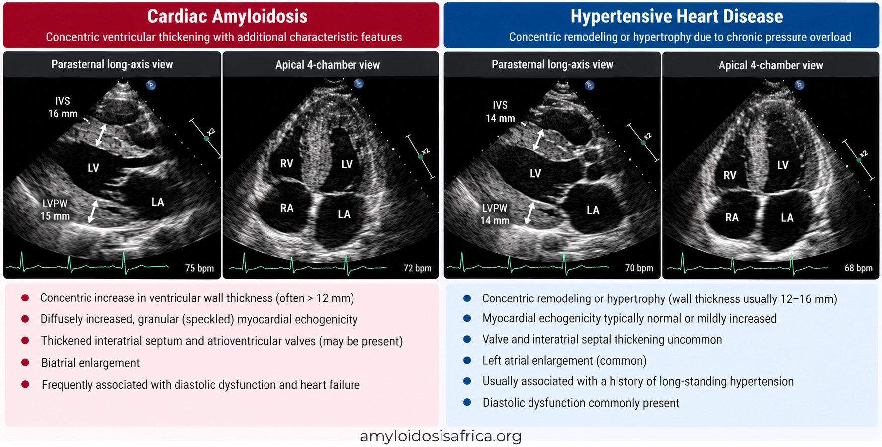 Echocardiographic comparison of cardiac amyloidosis and hypertensive heart disease showing concentric left ventricular wall thickening, atrial enlargement, and differences in myocardial structure.