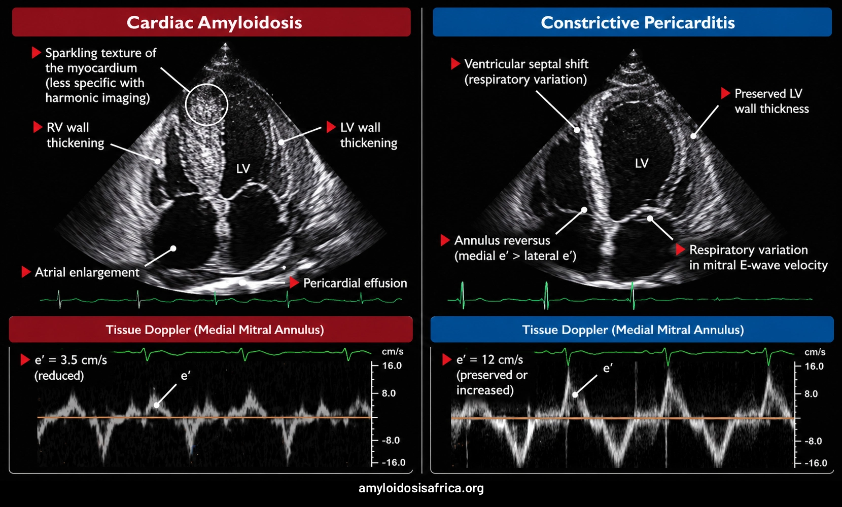 Echocardiographic comparison of cardiac amyloidosis and constrictive pericarditis showing ventricular wall thickening, septal shift and mitral annular tissue Doppler e′ velocities.